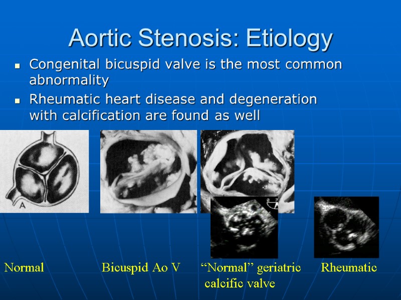 Aortic Stenosis: Etiology Congenital bicuspid valve is the most common abnormality Rheumatic heart disease